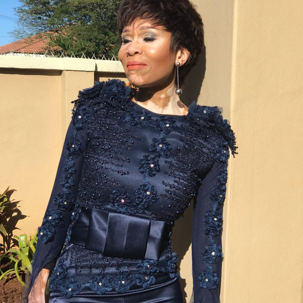 Leleti Khumalo Talks About How She Learned To Accept Her Skin Condition 1631