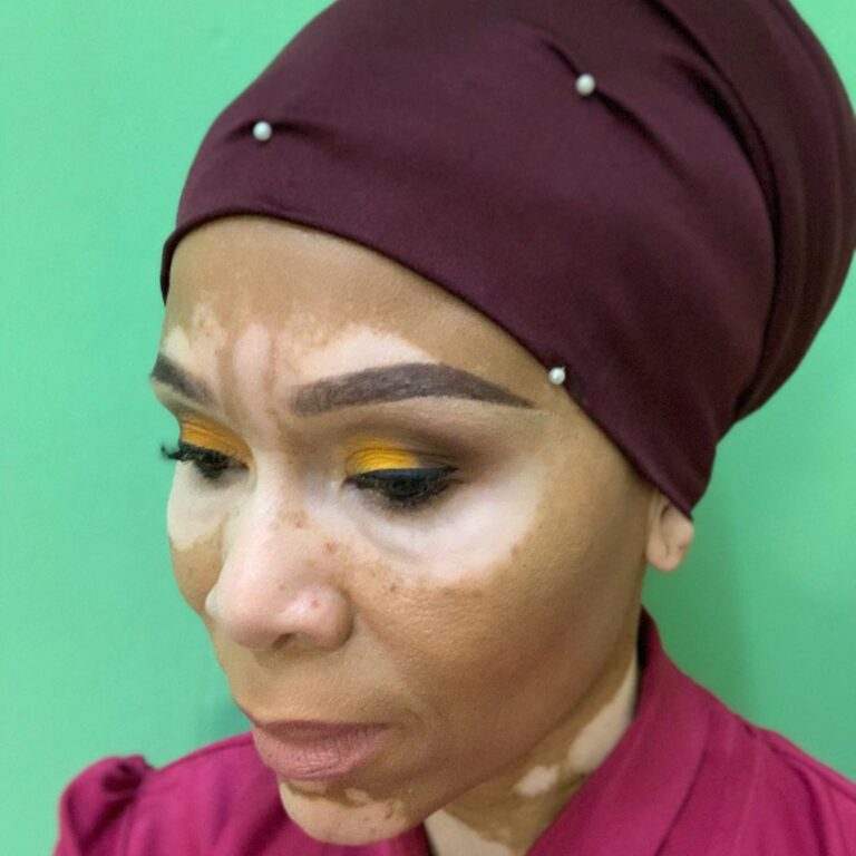 Leleti Khumalo talks about how she learned to accept her skin condition