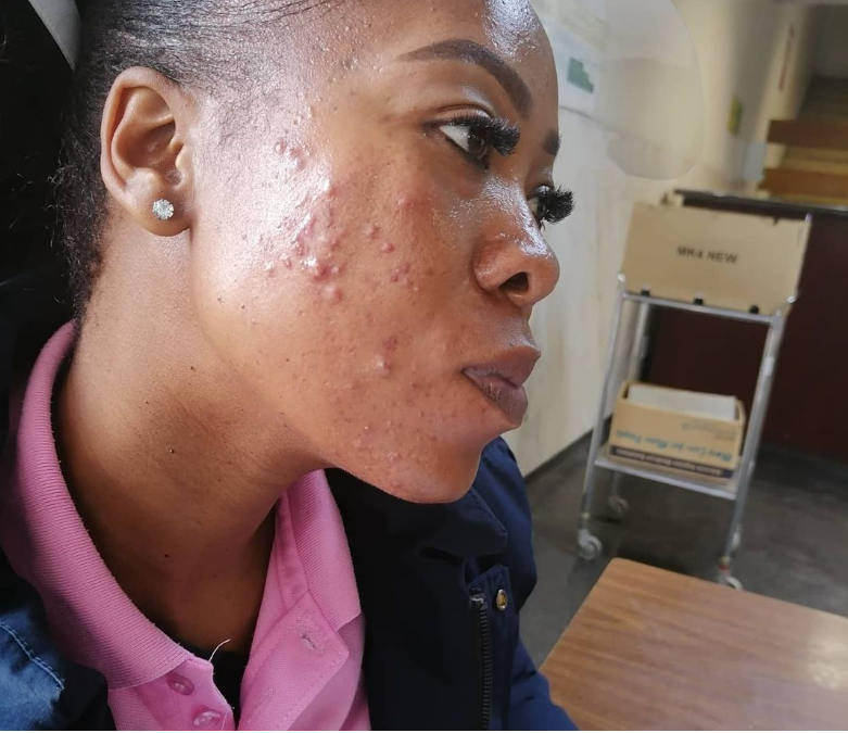 PHOTOS: SKOLOPAD STRUGGLING TO GET BOOKED AFTER AMID ACNE CAUSED BY FACE MASK