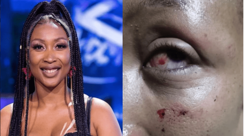 Former Idols SA Contestant Brutally Beaten-Up By Ex Boyfriend – Photos