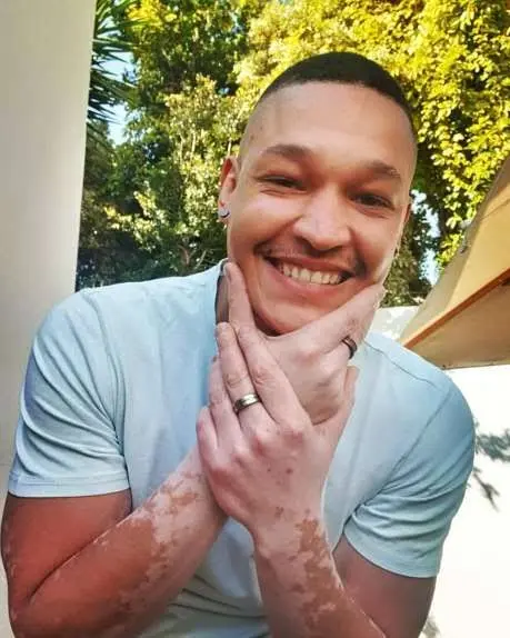 List of SA celebrities with vitiligo – Photos