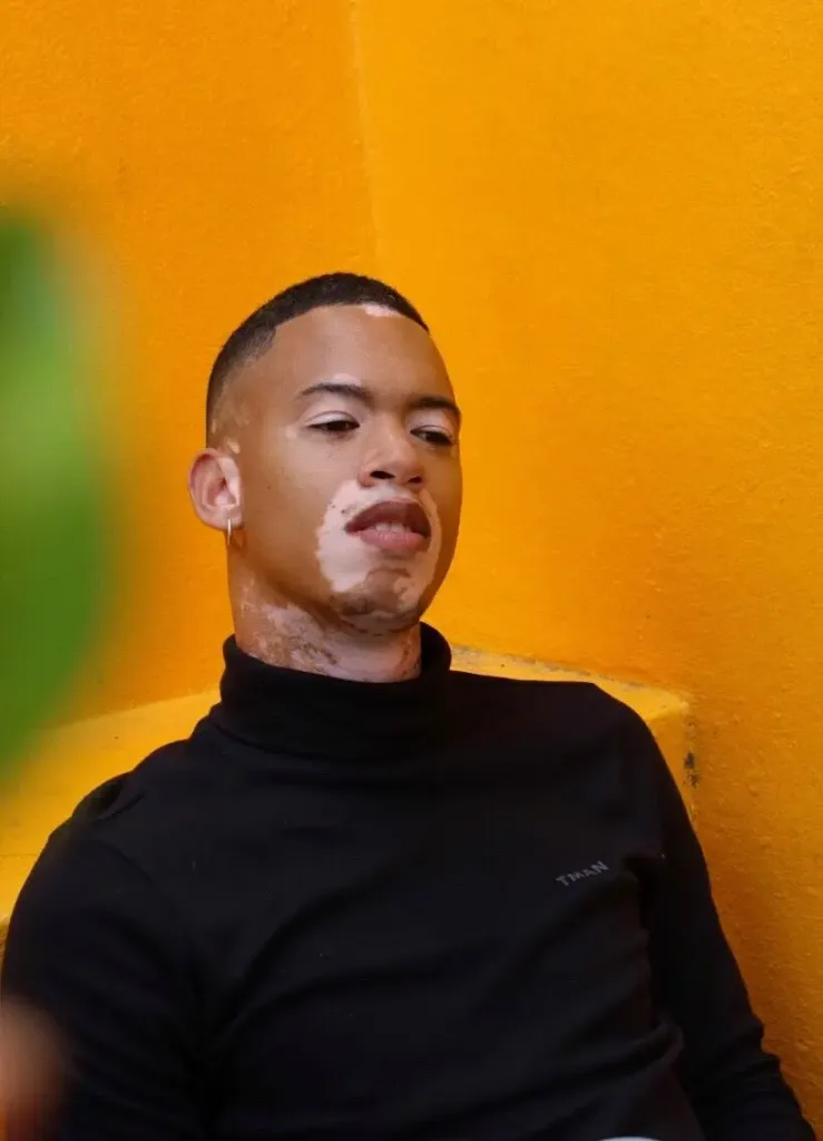List of SA celebrities with vitiligo – Photos