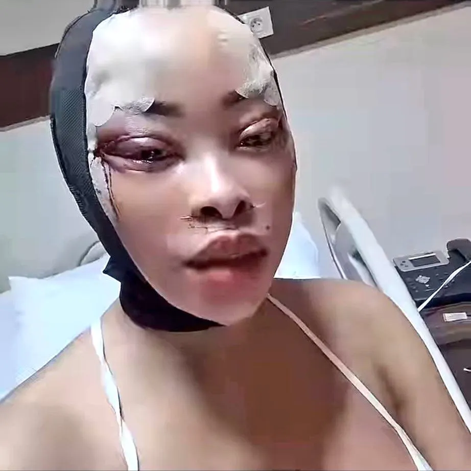 Video: Khanyi Mbau does another face surgery